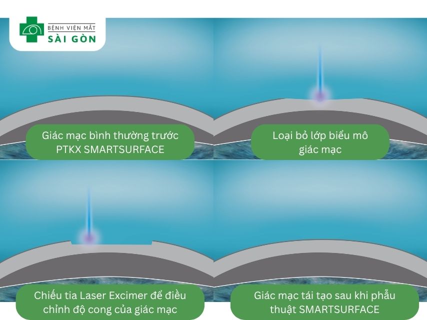 Phẫu thuật SMARTSURFACE là gì?