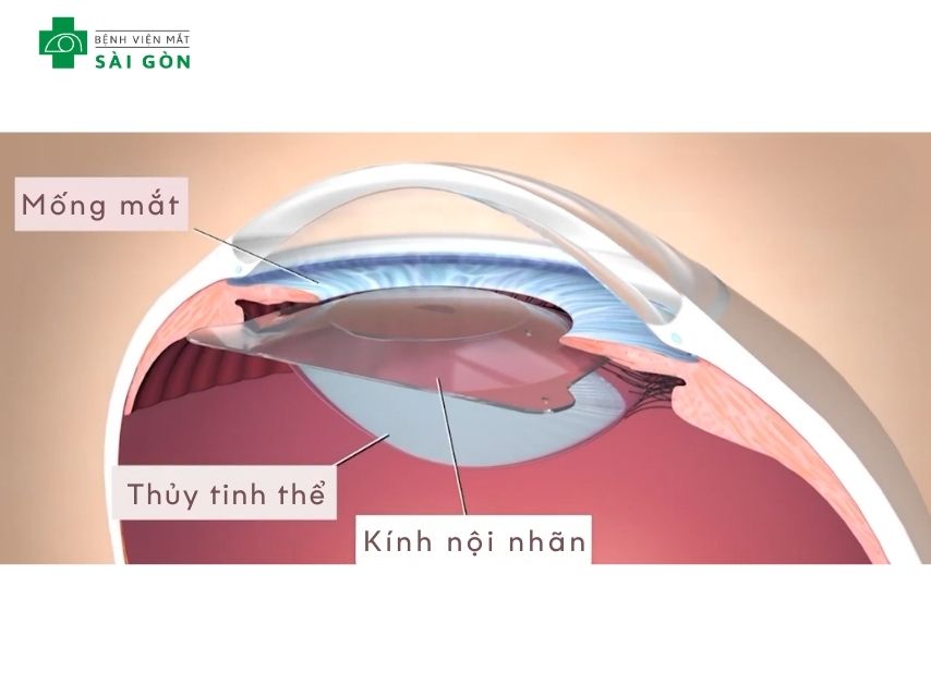 Phakic đặt thấu kính nội nhãn