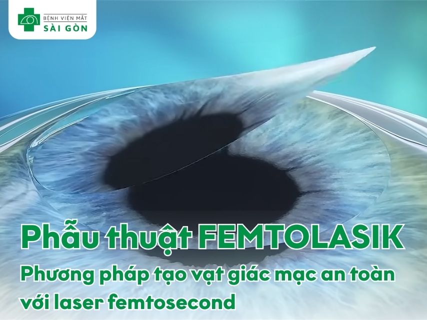 Tổng quan công nghệ mổ cận FEMTOLASIK