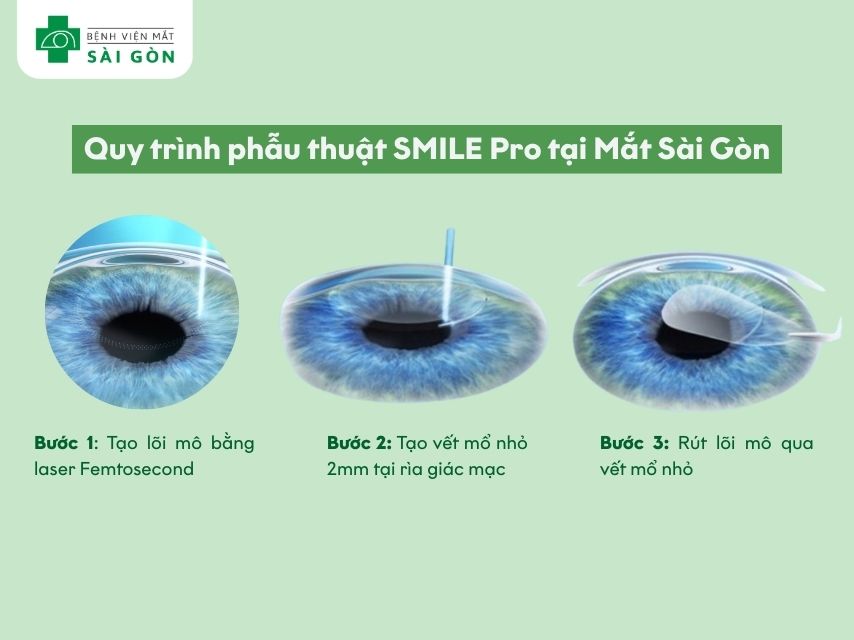 Các bước phẫu thuật SMILE Pro