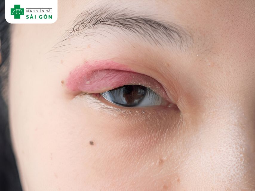 Rối loạn nội tiết khiến mí mắt bị sưng