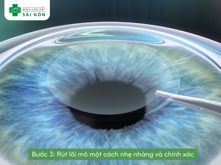 Kiểm tra thị lực và hoàn tất