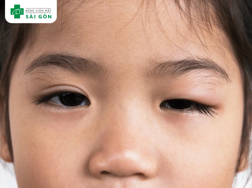 Trẻ em bẩm sinh có khả năng cao bị sụp mí