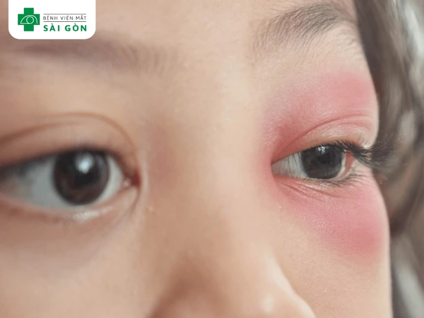 Các chấn thương ở mắt có thể gây sụp mí