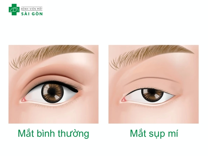 Mi trên mắt có vị trí thấp hơn bình thường khi nhìn thẳng