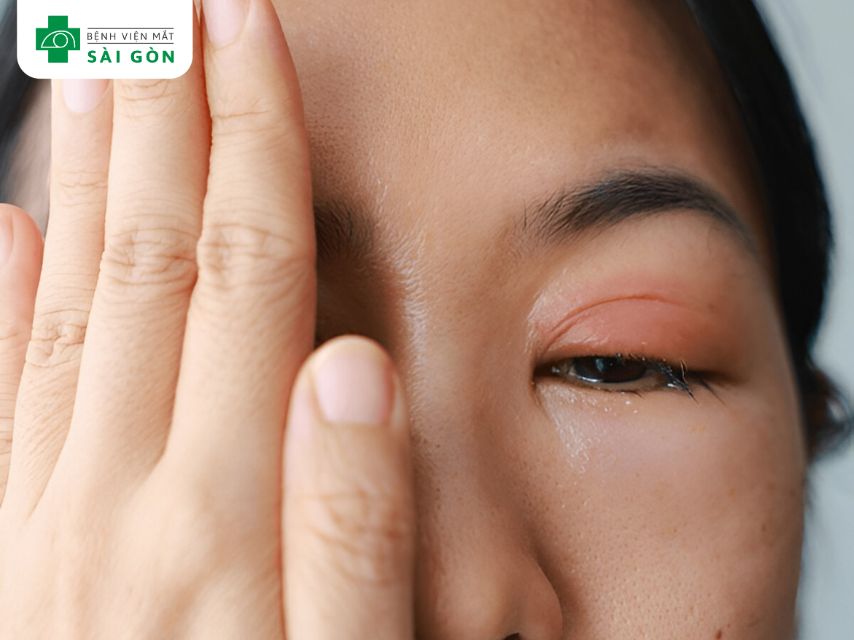 Tắc lệ đạo gây chảy nước mắt sống