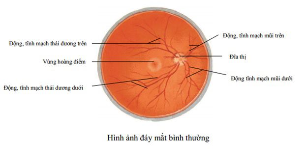 tăng sinh dịch kính võng mạc