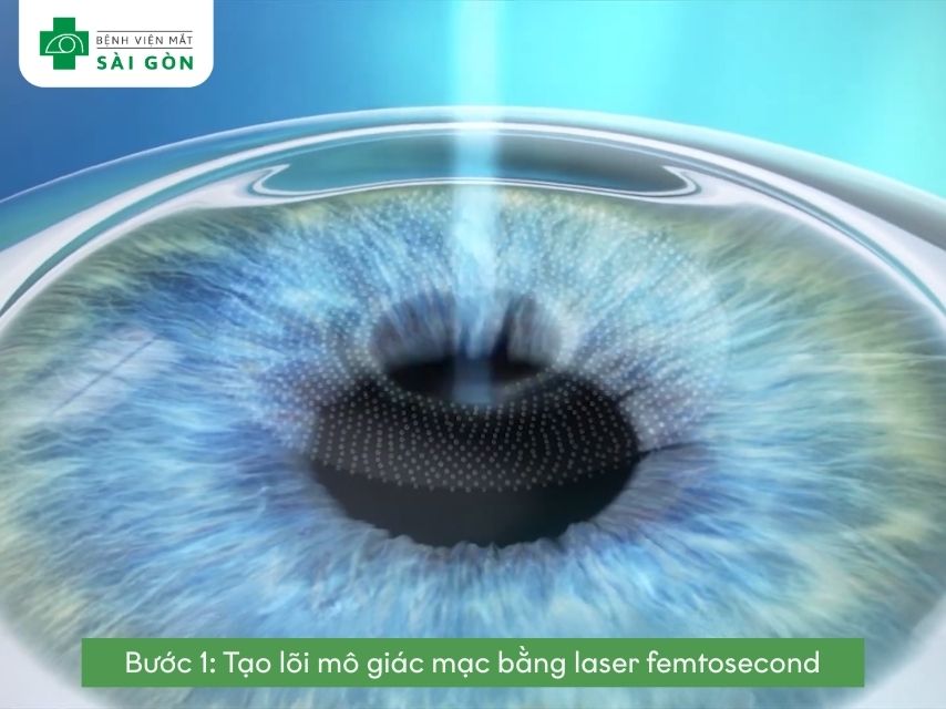  Tạo lõi mô bằng laser Femtosecond