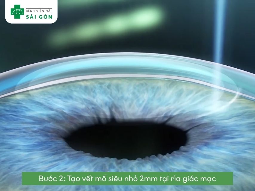 Tạo vết mổ 2mm rìa giác mạc