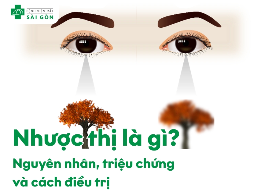 Tầm nhìn của người bị nhược thị so với mắt bình thường