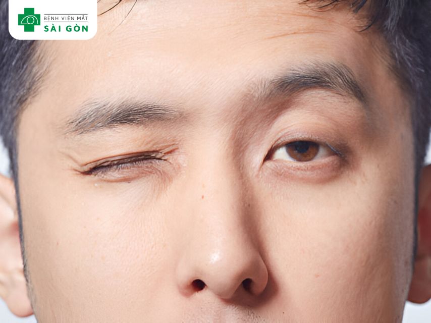 Co giật mí mắt do mí mắt trên hoặc dưới bị rung