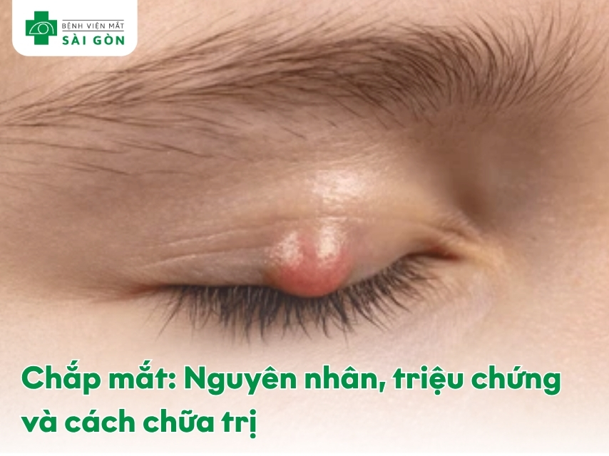 Chắp mắt với khối sưng đỏ ở mí