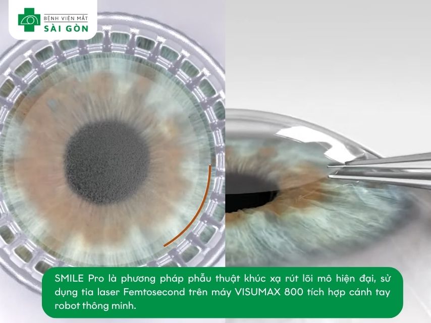 SMILE Pro mổ cận bằng laser Femtosecond