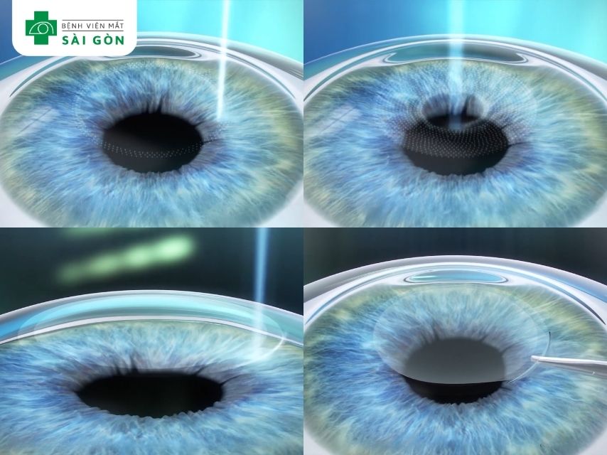 Phẫu thuật SMILE tạo lõi mô bằng Laser Femtosecond