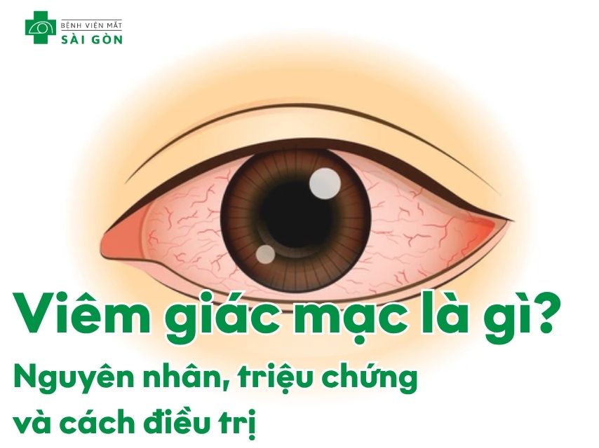 Tìm hiểu bệnh viêm giác mạc