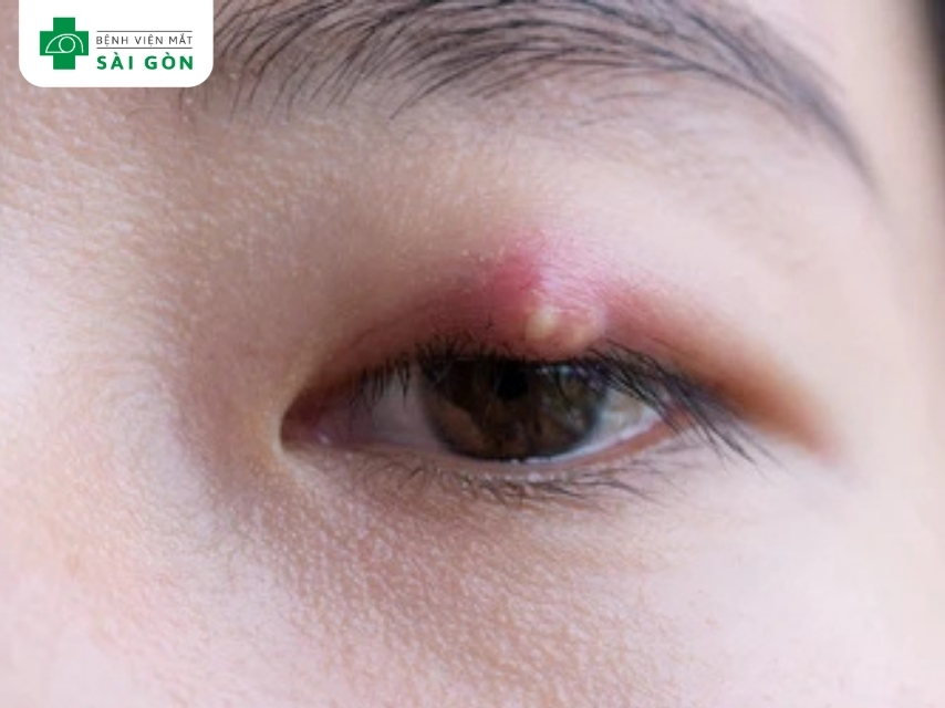 Chắp mắt biểu hiện dưới dạng khối u nhỏ ở mắt