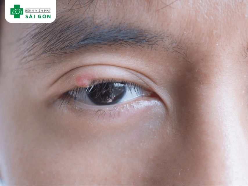 Lẹo mắt thường xuất hiện dạng cục sưng cứng rìa mi