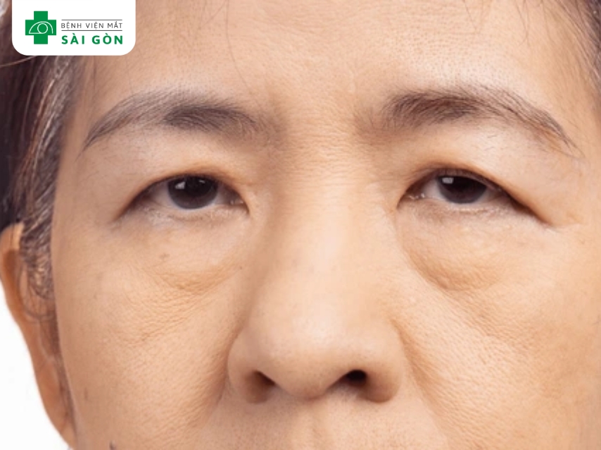Mí mắt bị sụp xuống là dấu hiệu phổ biến của bệnh