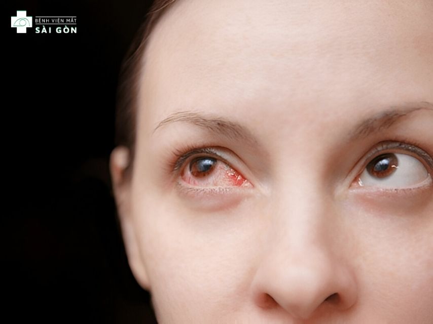 Đối tượng cận 9 độ chống chỉ định phẫu thuật