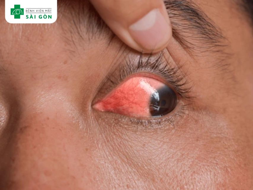 Viêm giác mạc có nguy hiểm không