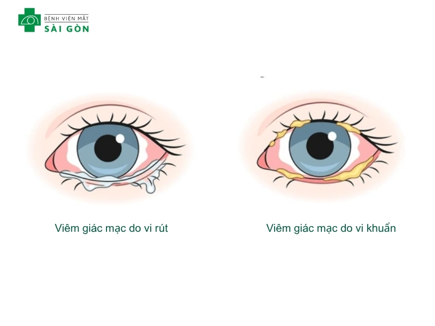 Viêm giác mạc do virus và vi khuẩn có tính lây lan