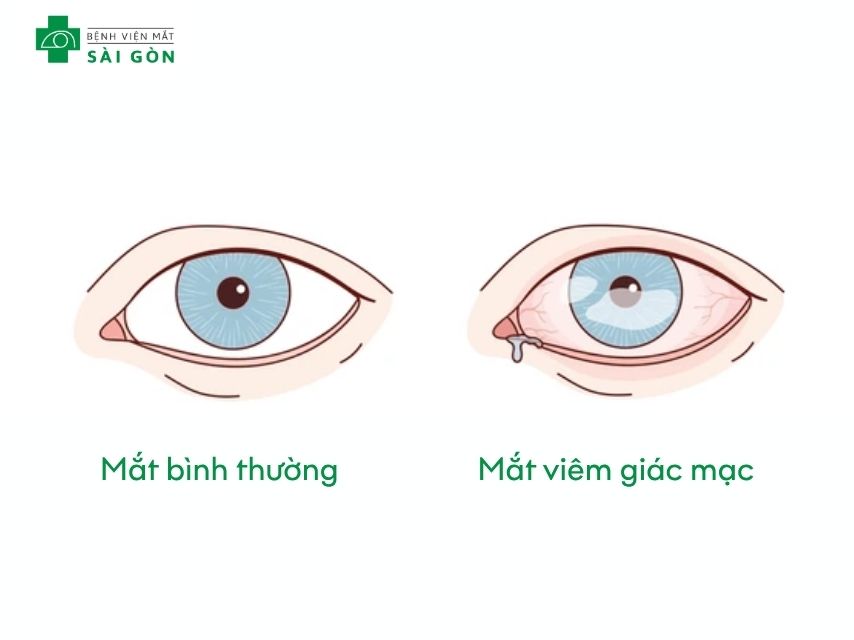 Bệnh viêm giác mạc là gì