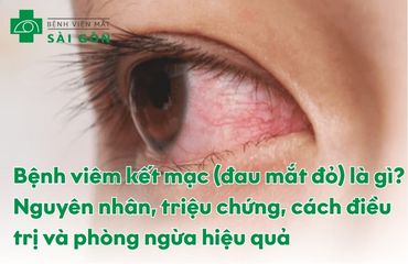 Bệnh viêm kết mạc (đau mắt đỏ)
