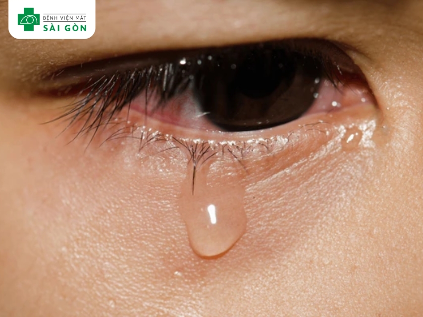 Dấu hiệu viêm kết mạc dị ứng