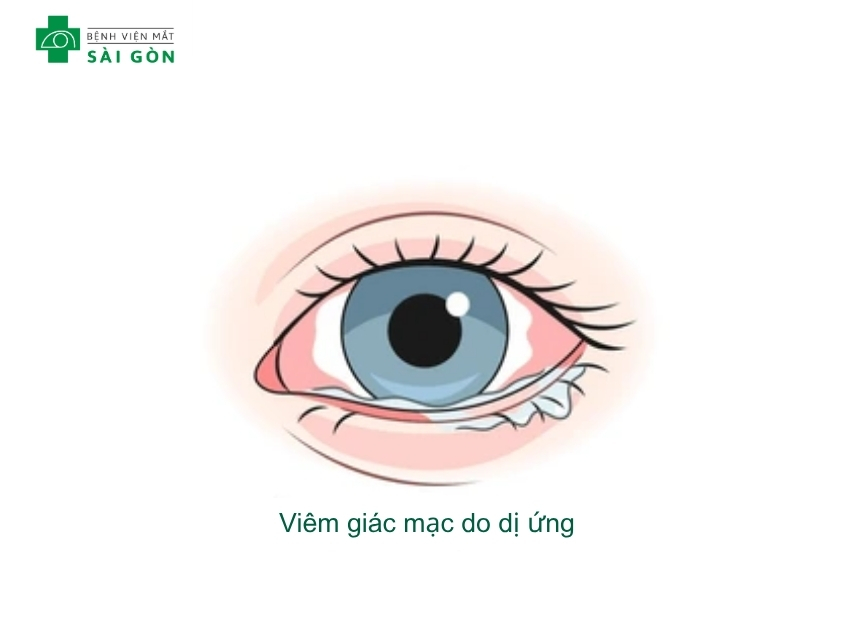 Tình trạng viêm kết mạc dị ứng