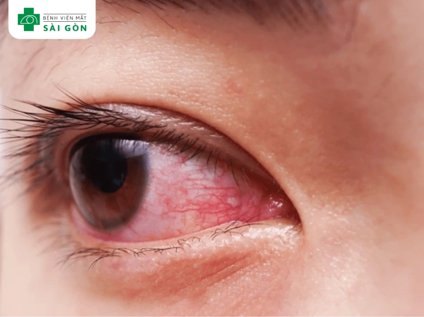 Viêm kết mạc do kích ứng bởi nhiều yếu tố