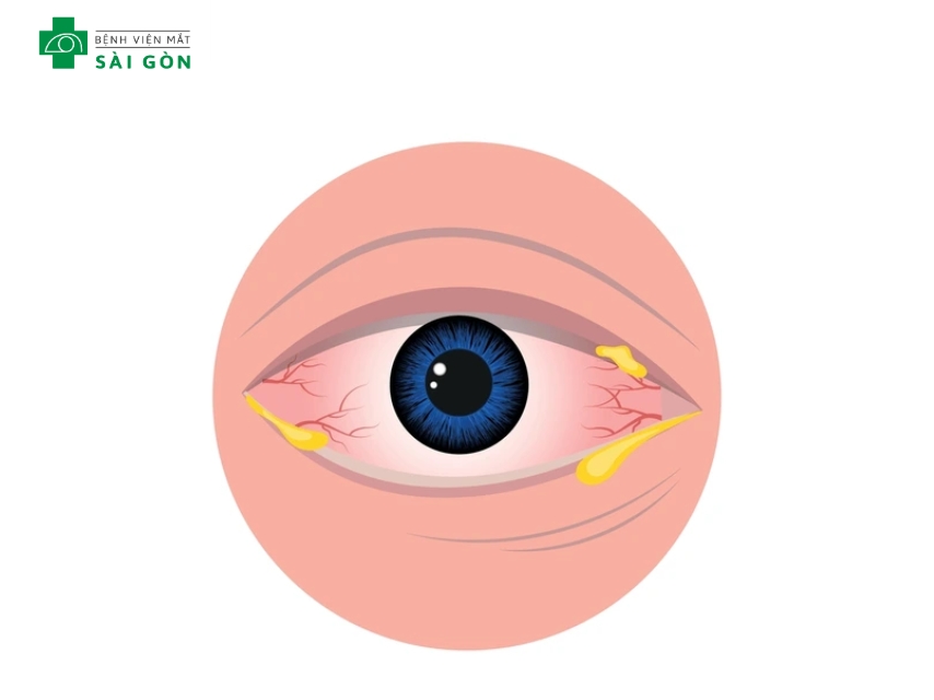 Dấu hiệu viêm kết mạc do vi rú, vi khuẩn