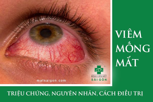 viêm mống mắt